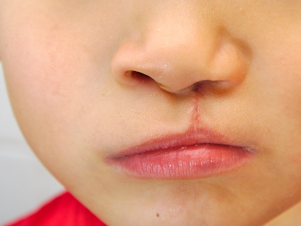 Niño con labio palatina