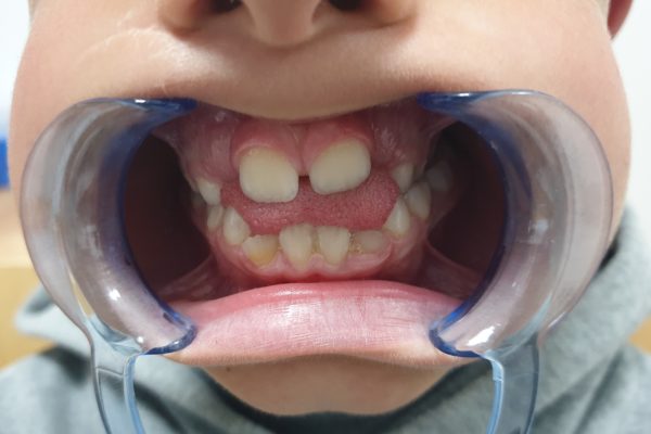 deglucion atipica reeducar la lengua